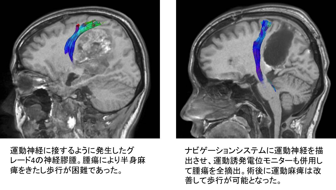 手術 後遺症 脳腫瘍