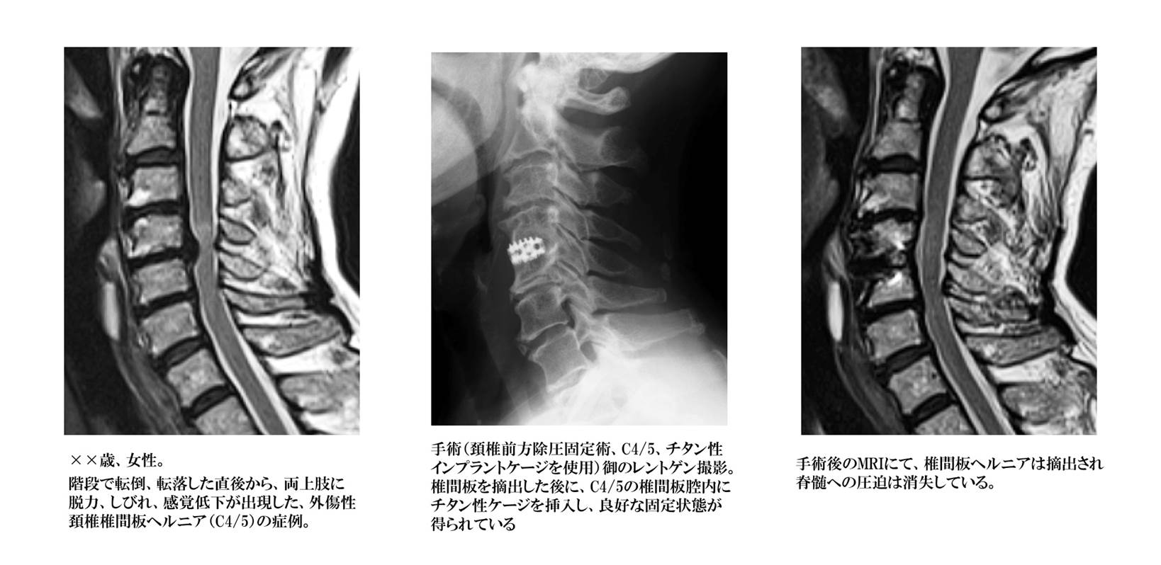 圧迫 第 骨折 腰椎 三