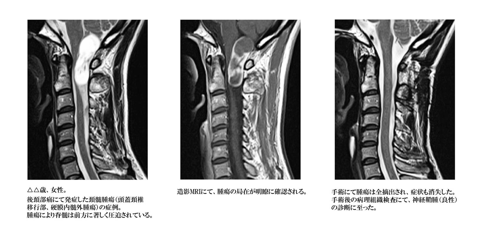 腰椎 圧迫 三 骨折 第