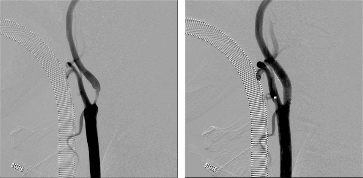 Mri ステント