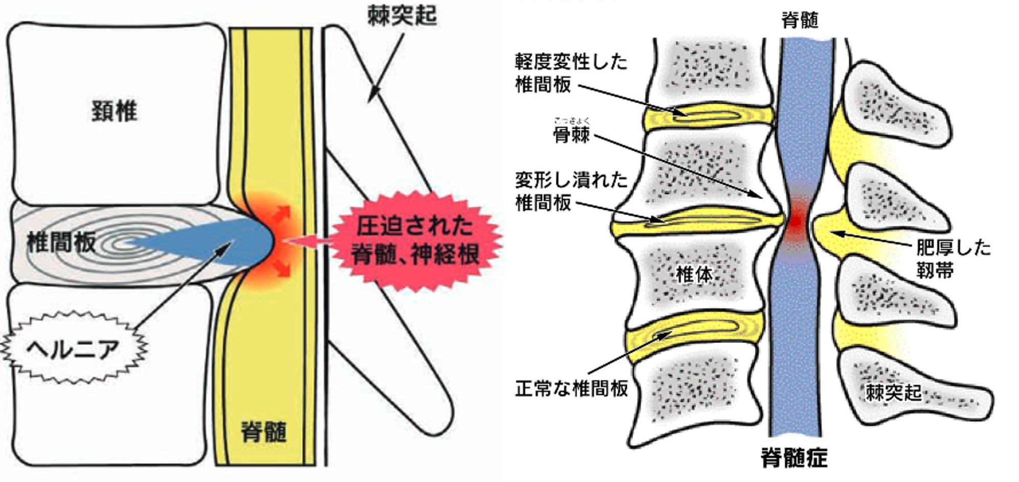 椎間板 ヘルニア 頚椎