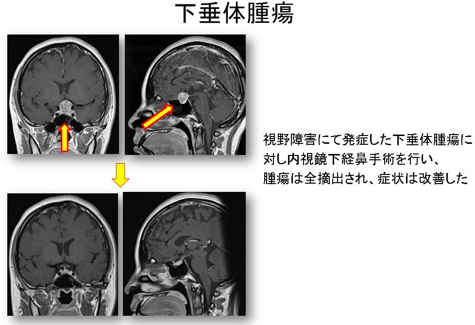 下垂体腫瘍