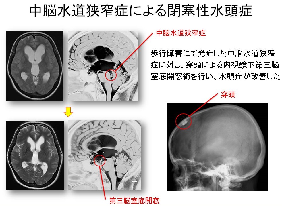中脳水道狭窄症による閉塞性水頭症